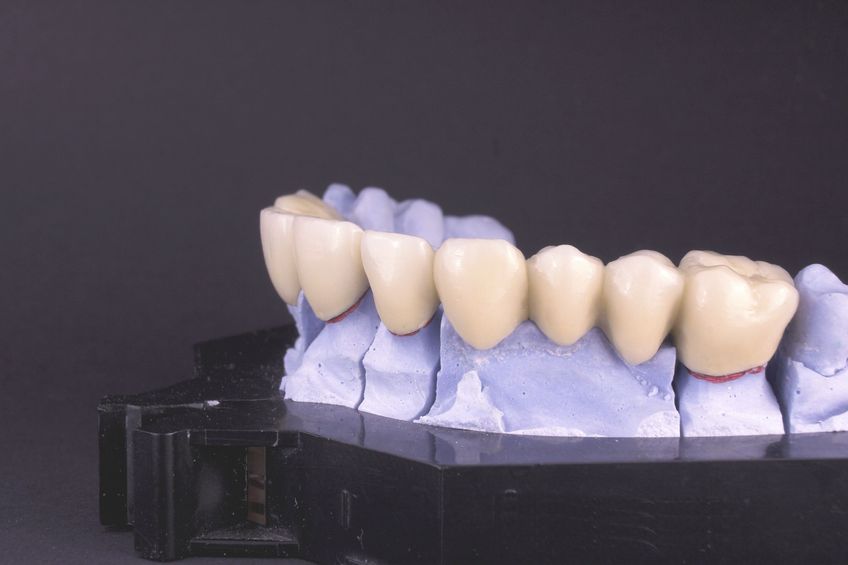 What Can You Expect From Dental Crowns?